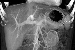 Cirrhosis - CTisus CT Scan