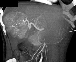 Hepatoma - CTisus CT Scan