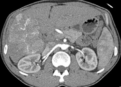 Hepatoma - CTisus CT Scan