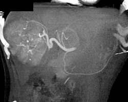 Hepatoma - CTisus CT Scan