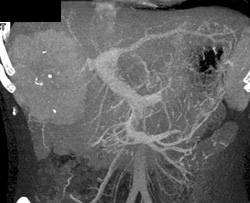 Hepatoma - CTisus CT Scan