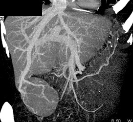 Focal Nodular Hyperplasia (FNH) - CTisus CT Scan