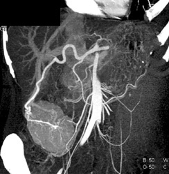 Focal Nodular Hyperplasia - CTisus CT Scan