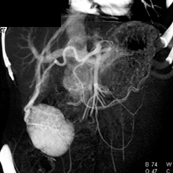 Focal Nodular Hyperplasia (FNH) - CTisus CT Scan