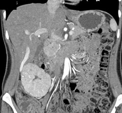 Focal Nodular Hyperplasia (FNH) - CTisus CT Scan