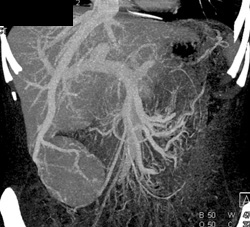 Focal Nodular Hyperplasia (FNH) - CTisus CT Scan