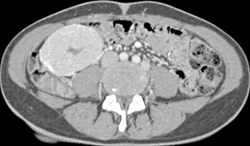 Focal Nodular Hyperplasia (FNH) - CTisus CT Scan