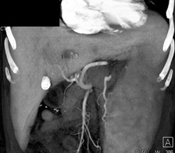 Hepatoma in Glycogen Storage Disease - CTisus CT Scan