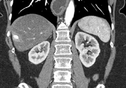 Hemangioma - CTisus CT Scan