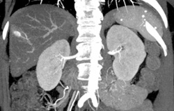 Hemangioma - CTisus CT Scan