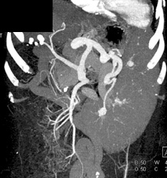 Cirrhosis - CTisus CT Scan