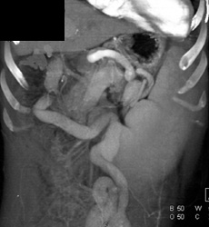 Cirrhosis With Varices - CTisus CT Scan