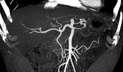 Splenic Artery Encased By Tumor - CTisus CT Scan