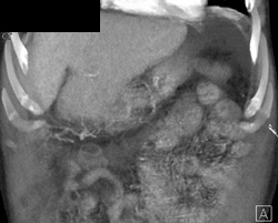 Cirrhosis - CTisus CT Scan