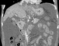 Cirrhosis With Hepatoma and Extension Into IVC - CTisus CT Scan