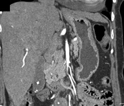 Normal Celiac Axis - CTisus CT Scan