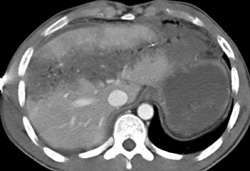 Liver Laceration and Pericardial Injury - CTisus CT Scan