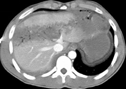 Liver Laceration - CTisus CT Scan