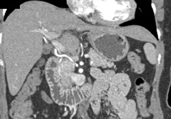 Hepatic Artery Off Aorta - CTisus CT Scan