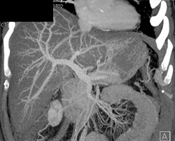 Fatty Liver - CTisus CT Scan