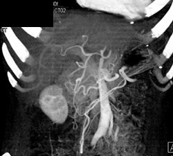 Normal Hepatic Artery - CTisus CT Scan