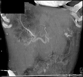 Hepatoma - CTisus CT Scan