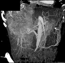 Hepatoma - CTisus CT Scan