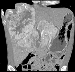 Hepatoma - CTisus CT Scan