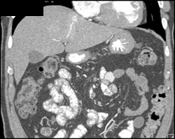 Carcinoid Metastatic to Liver - CTisus CT Scan