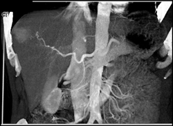 Hepatoma - CTisus CT Scan