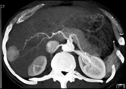 Hepatoma - CTisus CT Scan