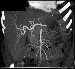 Normal Hepatic Artery - CTisus CT Scan