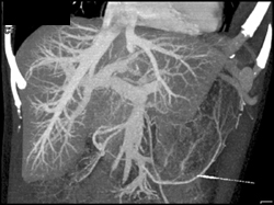 Normal Hepatic Vein - CTisus CT Scan