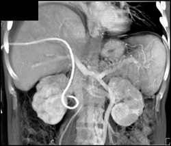 Cholangiocarcinoma - CTisus CT Scan