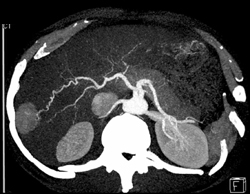 Hepatoma - CTisus CT Scan