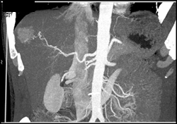 Hepatoma - CTisus CT Scan