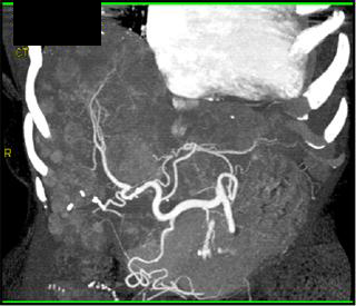 Metastatic Islet Cell Tumor - CTisus CT Scan