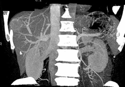 Hepatoma - CTisus CT Scan