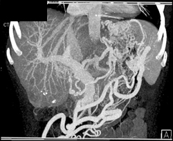 Extreme Gastric Varices - CTisus CT Scan