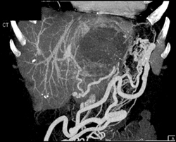 Extensive Gastric Collaterals Due to Splenic Vein Encasement - CTisus CT Scan