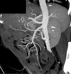 Hepatic Arterial Anatomy - CTisus CT Scan