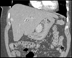 Hemangioma - CTisus CT Scan