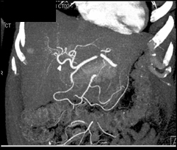 1.hemangioma 2.normal Hepatic Arterial Anatomy - CTisus CT Scan