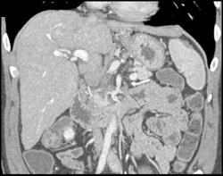 Cirrhosis - CTisus CT Scan