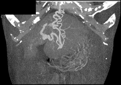 Varices in Abdominal Wall - CTisus CT Scan