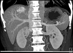 Hemangioma - CTisus CT Scan