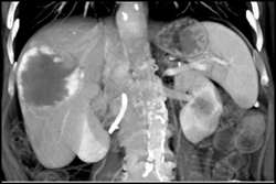 Hemangioma - CTisus CT Scan