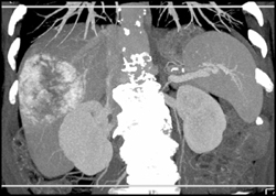 Hemangioma - CTisus CT Scan