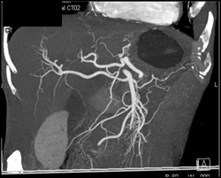 Replaced Right Hepatic Artery Off SMA - CTisus CT Scan