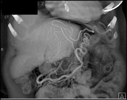 Cirrhosis With Varices - CTisus CT Scan